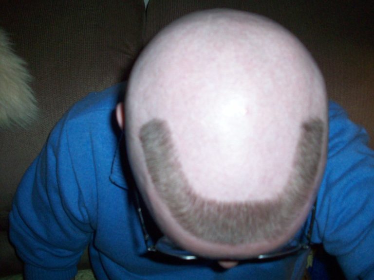 The Biggest Contribution Of Horseshoe Haircut To Humanity horseshoe