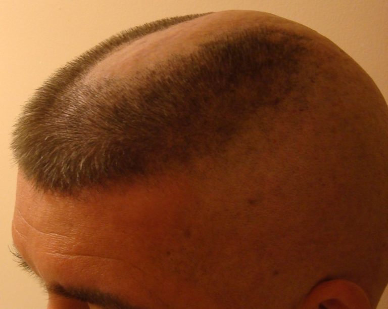 The Biggest Contribution Of Horseshoe Haircut To Humanity horseshoe