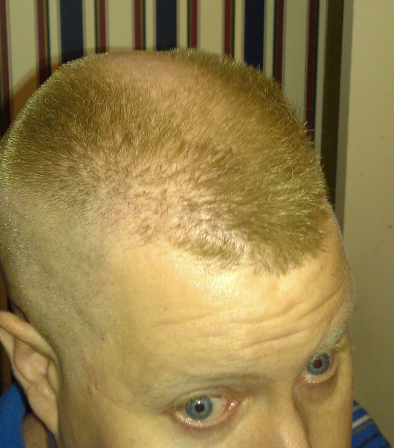 The Biggest Contribution Of Horseshoe Haircut To Humanity horseshoe